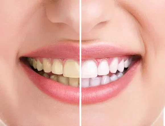 Jak wybielić zęby za pomocą naturalnych środków?