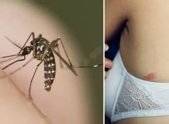 Główne zdjęcie - Domowe sposoby na swędzące ukąszenia po komarach