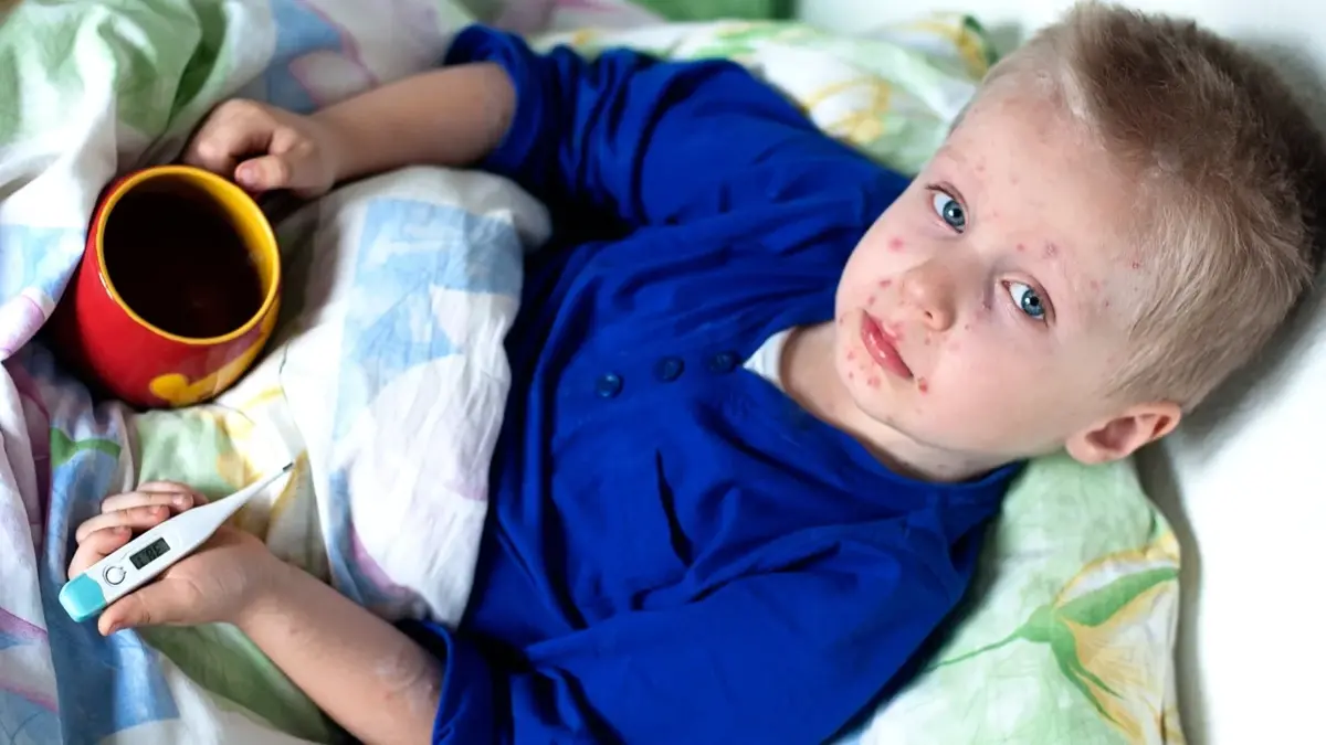 Chłopczyk chory na ospę wietrzną leżący w łóżku 