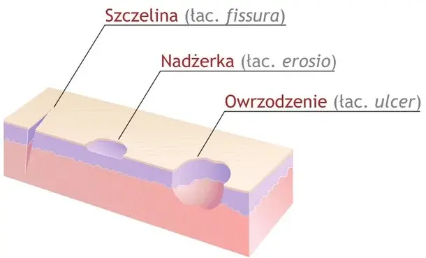 5 sposobów leczenia nadżerki