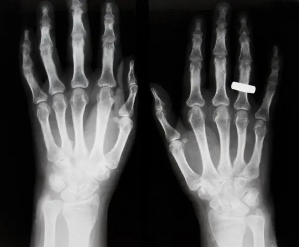 Główne zdjęcie - Osteoporoza - co powinnam o niej wiedzieć?