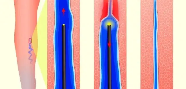 8 sposobów na domowe leczenie żylaków