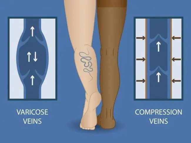 8 sposobów na domowe leczenie żylaków