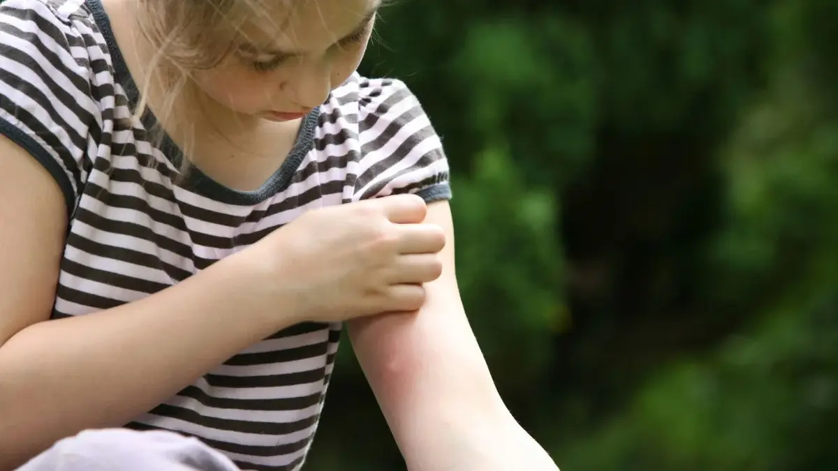 Dziecko boli ręka przez ugryzienie komara w ogrodzie