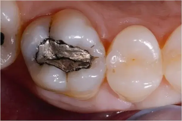 Główne zdjęcie - Fakty i mity na temat wypełnień zęba amalgamatem