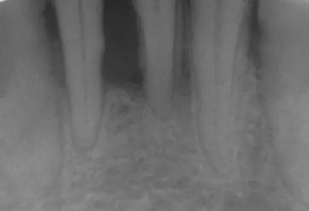 W jaki sposób leczyć zapalenie dziąseł? – 6 sposobów