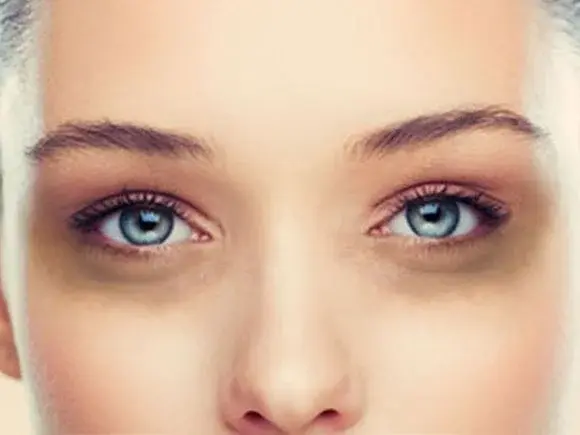 Jak pozbyć się cieni pod oczami - domowe sposoby