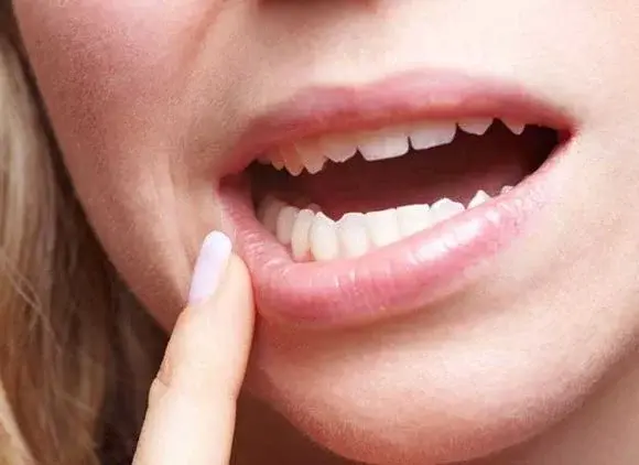Jak leczyć pęknięte kąciki ust?