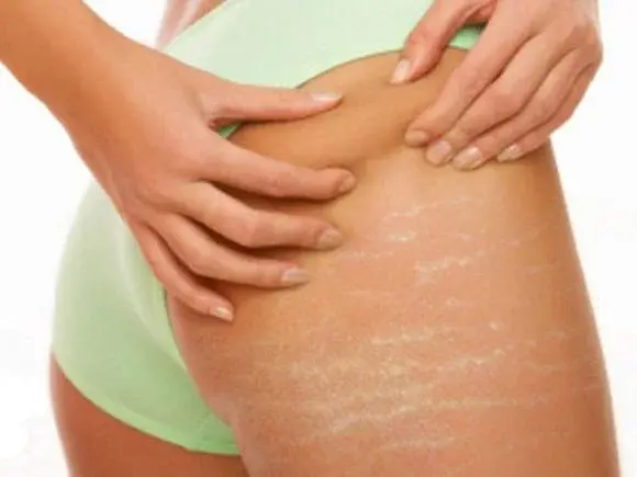 Jak pozbyć się rozstępów?