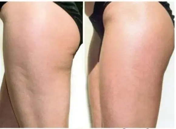 Jak zwalczyć cellulit do lata?