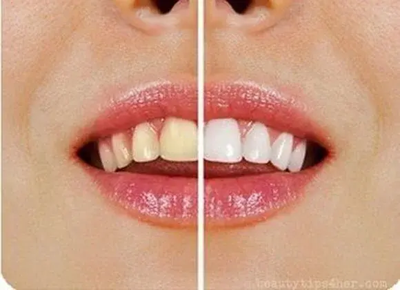 Jak samodzielnie wybielić zęby?