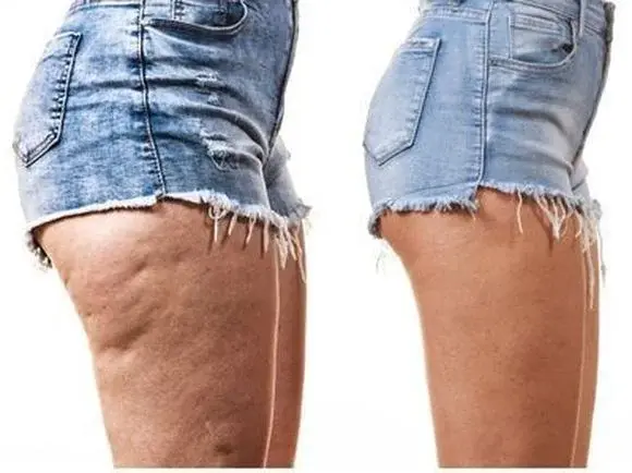 Domowe sposoby na skórkę pomarańczową