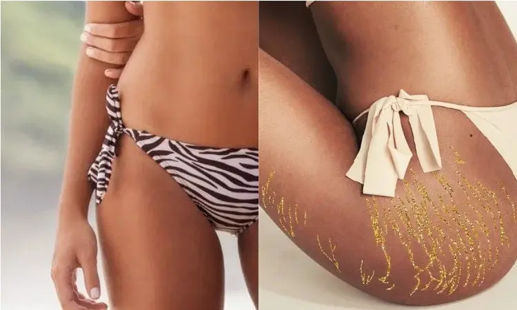 Rozstępy - jak pozbyć się rozstępów?