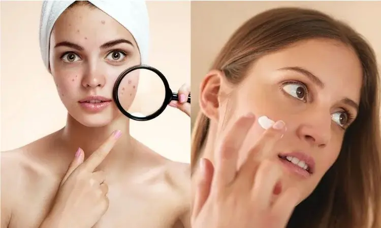 Cera trądzikowa - jak dbać o cerę trądzikową?