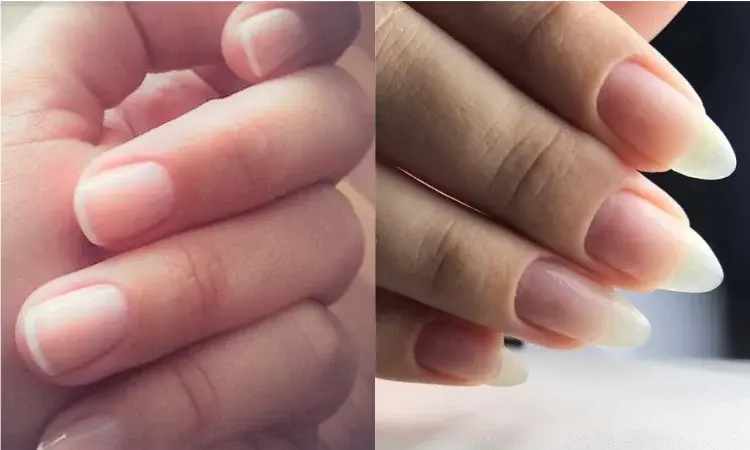 Główne zdjęcie - Rozdwajające się paznokcie - przyczyny i leczenie. Co zrobić, kiedy paznokcie się rozdwajają?