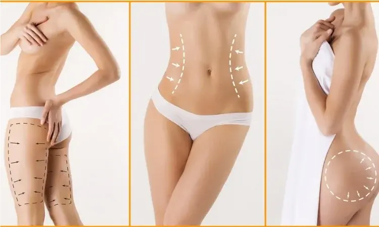 Liposukcja niejedno ma imię - jaki zabieg wybrać? Poznaj wskazówki specjalistów!