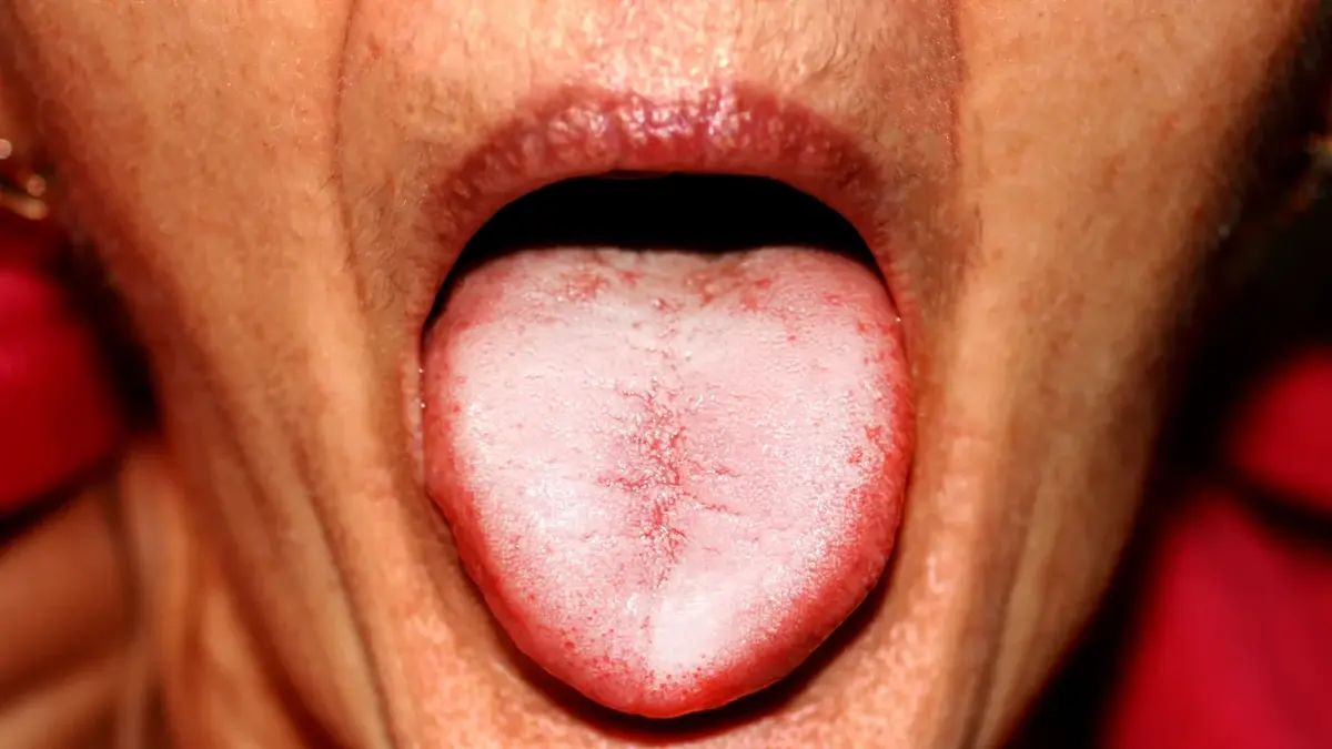 biały nalot na języku