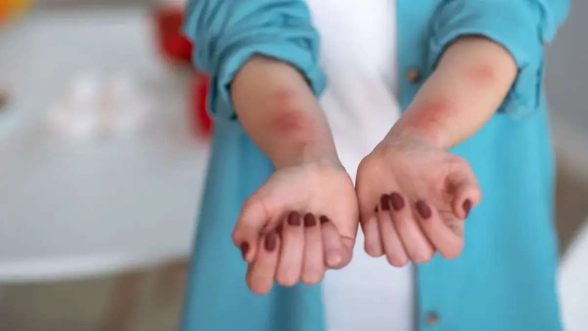 pokrzywka alergiczna