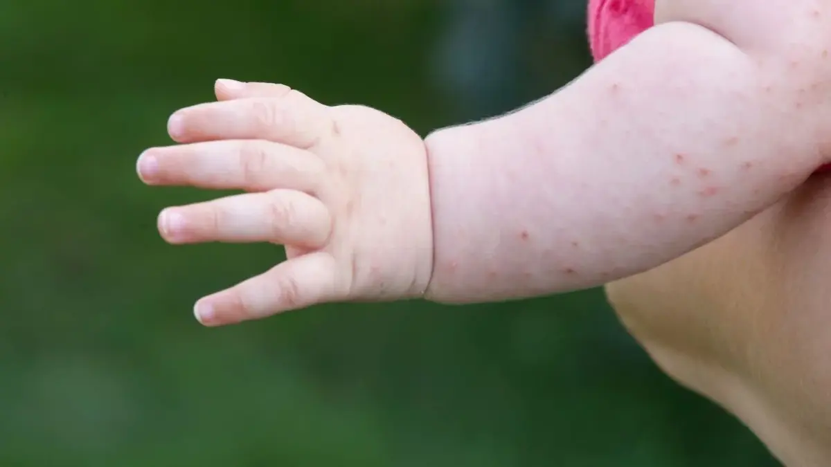 Potówki u niemowlaka