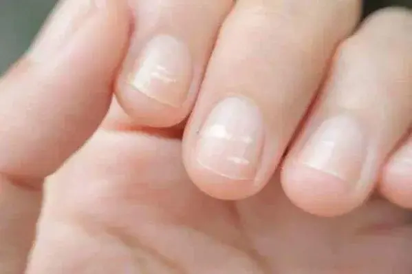 Białe plamki na paznokciach - co oznaczają? Jak sobie z nimi poradzić?