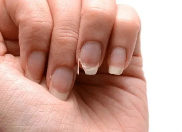 Rozdwajające się paznokcie - przyczyny i leczenie. Co zrobić, kiedy paznokcie się rozdwajają?