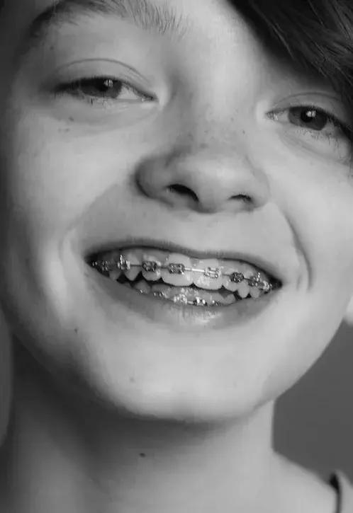 Czarno białe zdjęcie chłopca w uśmiechu pokazującego tradycyjny aparat ortodontyczny zamiast przeźroczystych nakładek