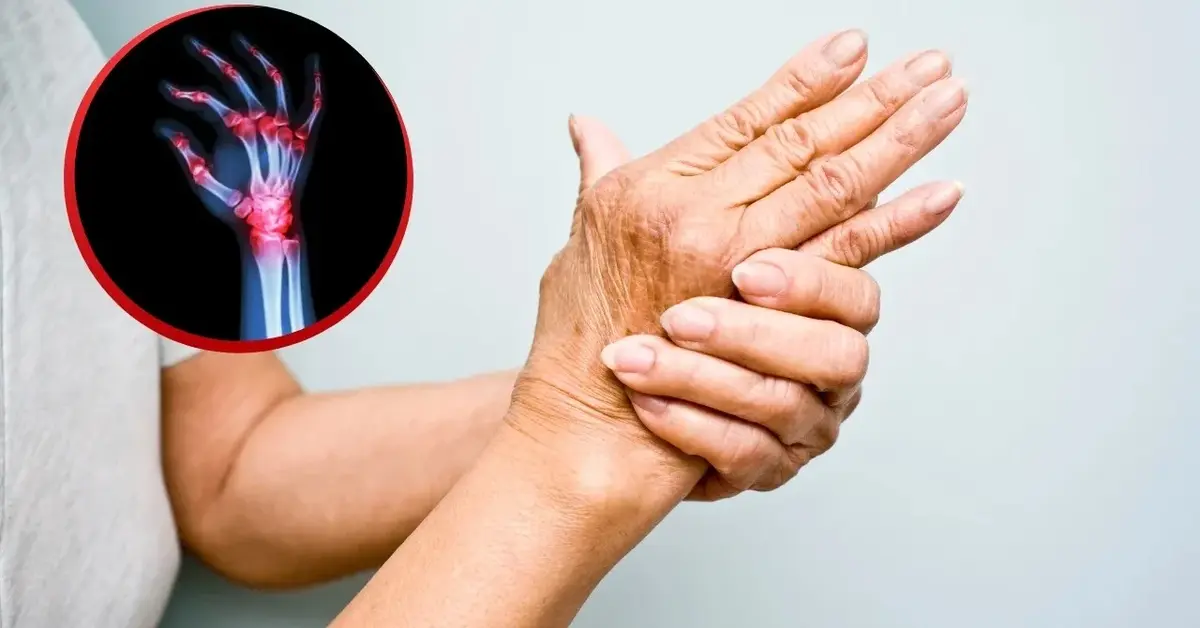 Dłonie kobiety z reaktywnym zapalniem stawów i zdjęcie prześwietlenia dłoni z zapaleniem zaznaczonym na czerwono.