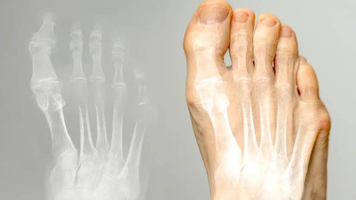 Stopa z halluksami, obok grafika układu kości w stopie