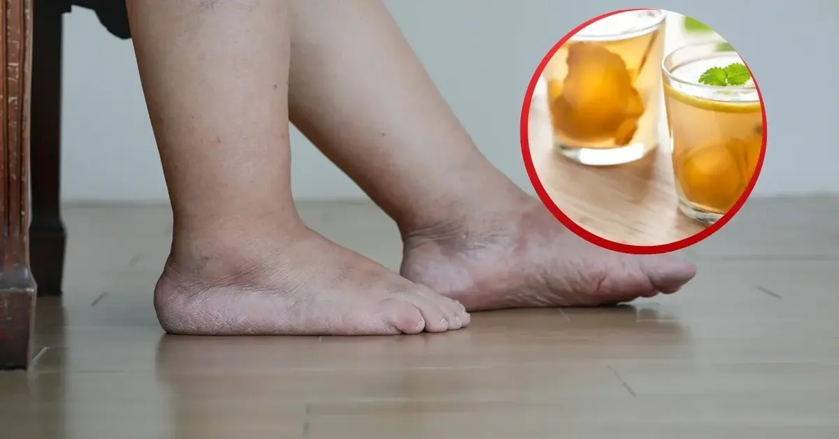 Napar z imbiru i stopy opuchnięte przez zatrzymywanie wody w organizmie.