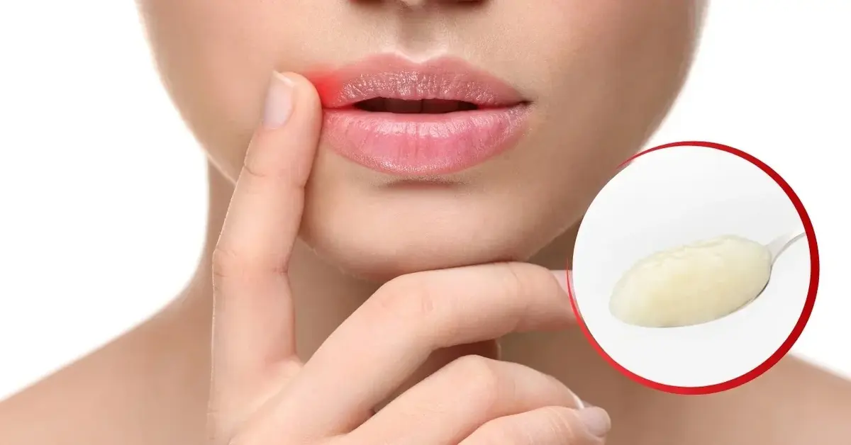 Kobieta z zajadem i pasta czosnkowa na zajady.