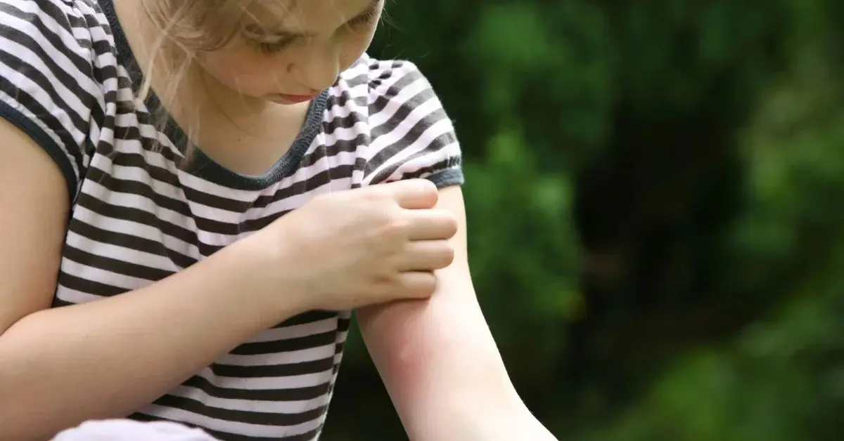 Kobieta drapie rękę po ukąszeniu przez komara