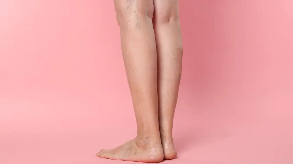 Żylaki na nogach kobiety stojącej na różowym tle 