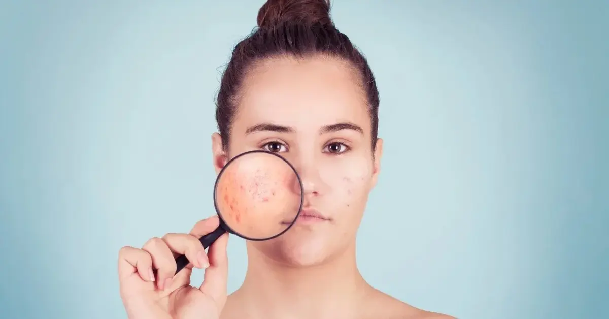 Trądzik hormonalny