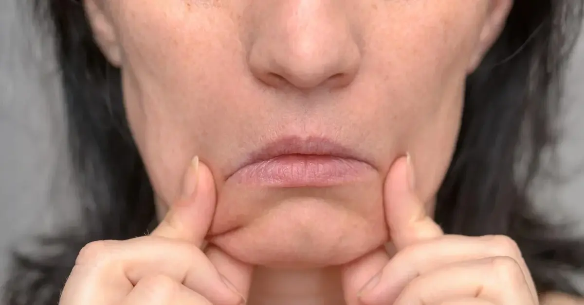 Zmarszczki marionetki u kobiety