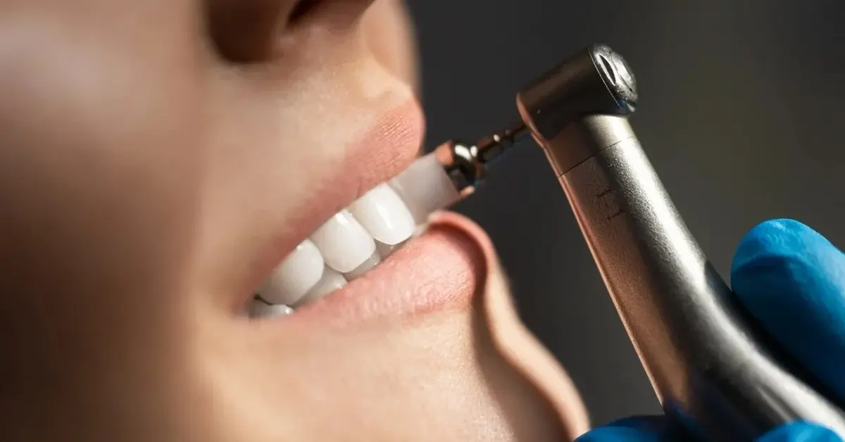 Usuwanie kamienia z zębów