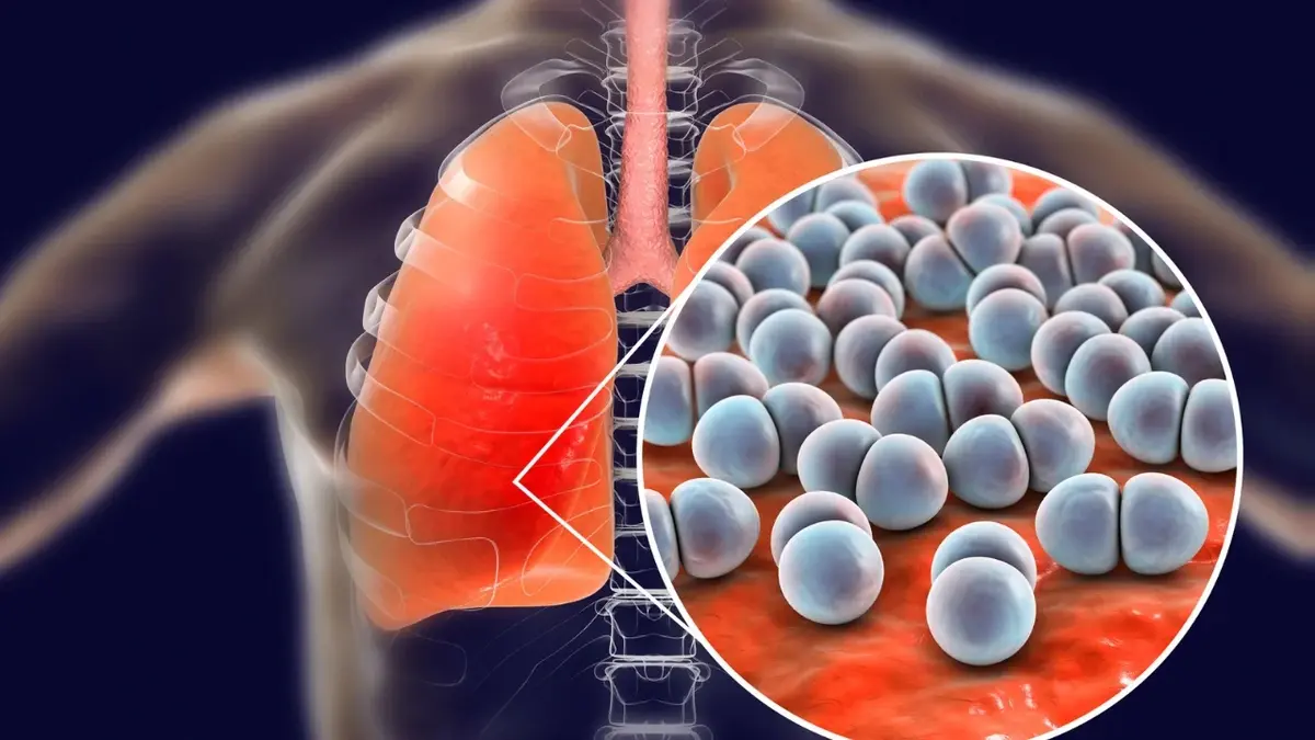 Pneumokoki przedstawione na grafice płuc