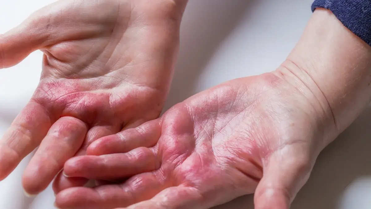 Zmiany skórne spowodowane azs na dłoniach 