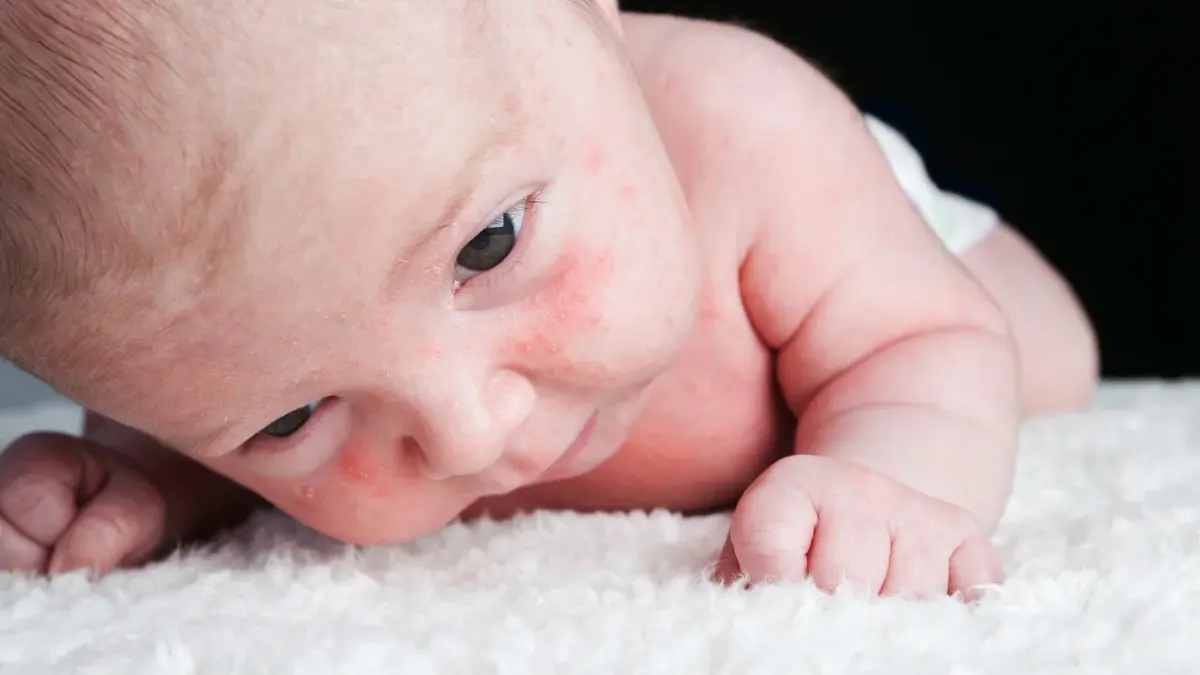 Trądzik niemowlęcy na twarzy niemowlaka