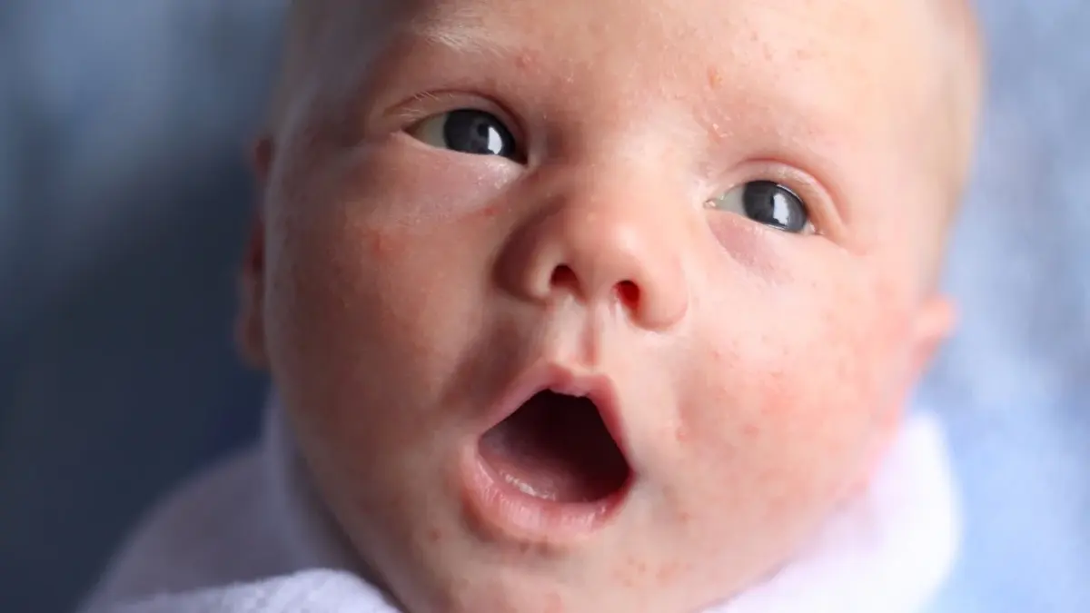 Trądzik niemowlęcy na twarzy niemowlaka